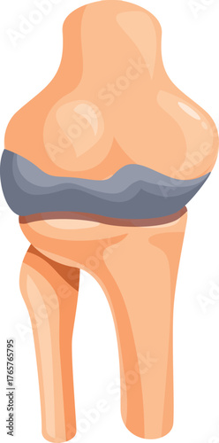 Prosthetic knee implant replacing damaged cartilage and bones, providing pain relief and restoring mobility