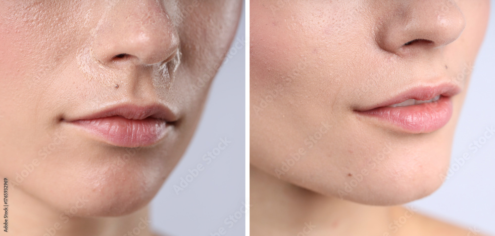 Obraz premium Woman with dry skin on face before and after moisturizing treatment, closeup. Collage of photos