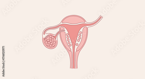 Illustration of a human uterus with an ovarian cyst.