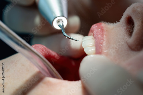 Close-up of ultrasonic teeth cleaning with scaler handpiece spraying water during professional dental hygiene procedure. Concept of oral care and preventive dentistry.