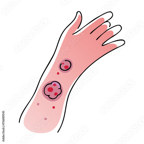 A cartoon illustration of an arm with red, inflamed skin lesions, symbolizing skin rash or irritation. Ideal for blogs on dermatology or health issues.