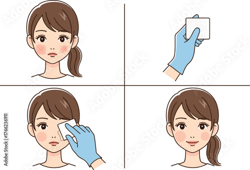 Skincare treatment process, irritated skin, alcohol pad cleaning, step-by-step illustration, facial care, medical hygiene, cartoon woman, isolated on white