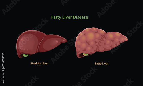 Illustration of Human Healthy Liver and Gallbladder and Fatty Liver Disease