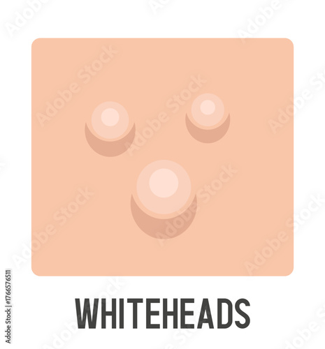 Closed comedone vector illustration. Whitehead. Acne type. Vector flat clipart
