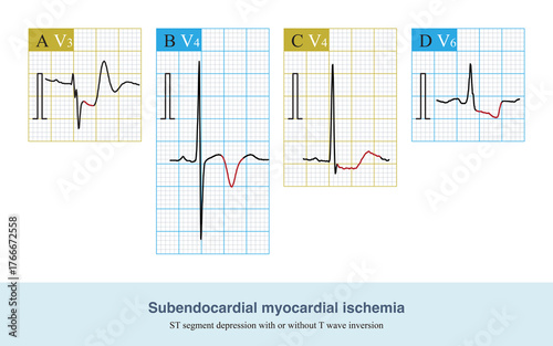 Tableau sur toile During subendocardial myocardial ischemia, ischemia is confined to subendocardial myocardium, and the main changes of ECG are ST segment depression and T wave inversion