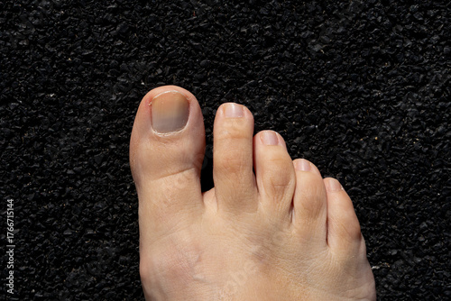 Yellow nail syndrome. Toenails. Before treatment.