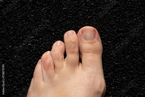 Yellow nail syndrome. Toenails. After treatment.