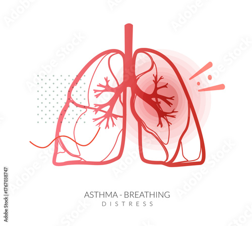Asthma - Lungs with Breathing Distress - Stock Illustration
