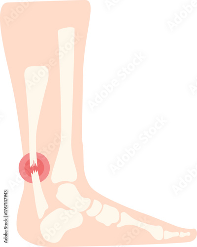leg bone pain