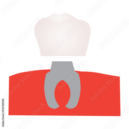 Dental Implant