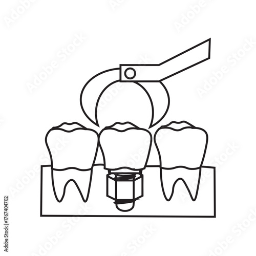 Molar Dental Implant Installation