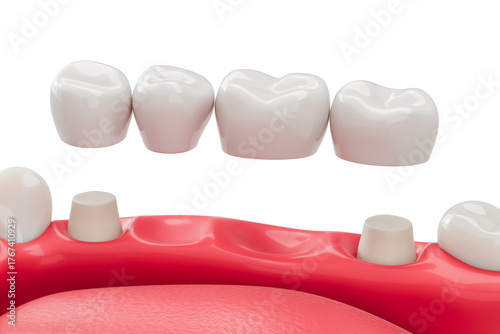 Tableau sur toile Dental bridge installation concept showing prosthetic teeth and abutment preparation on gum model for restorative dentistry procedure