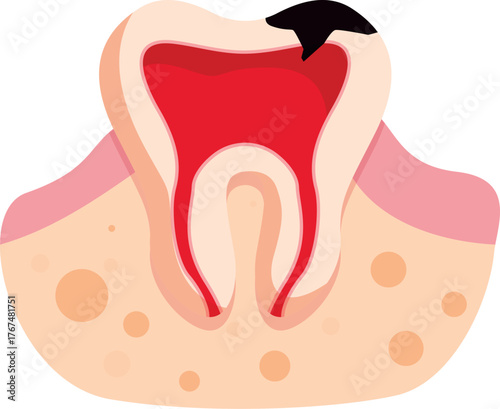 Cross section of molar showing deep decay reaching the pulp and root canal, emphasizing dental health importance