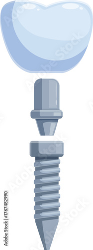 Exploded view of a dental implant showing the crown, abutment and screw fixture