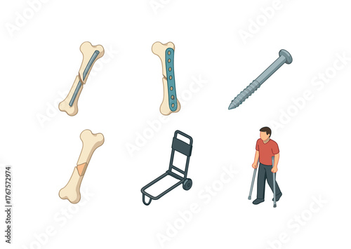 isometric icon items isolated on white background femoral fracture intramedullary nail femoral fracture fixation plate femoral fracture cortical screw femoral fracture bone graft femoral