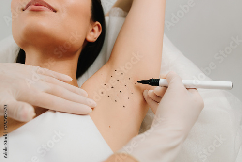 Fotografía Treatment of hyperhidrosis