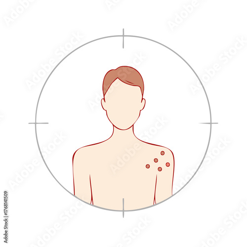 Illustrated person with rash or skin irritation on shoulder with targeting reticle overlay for concept on white