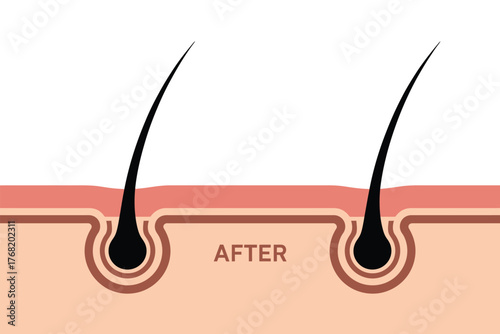 Illustration showing hair follicle after treatment with hair strands visible