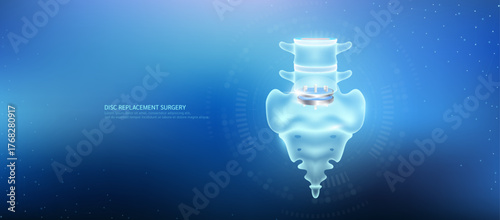Disc replacement. Prosthetic implant integrated into the spinal bone. Orthopedic technology artificial joint surgery in a transparent anatomical. Medical health care vector.