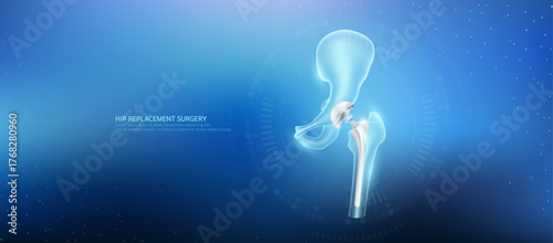 Hip replacement. Prosthetic implant integrated into the femur bone. Orthopedic technology artificial joint surgery in a transparent anatomical. Medical health care vector.