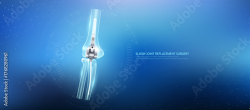 Total elbow arthroplasty. Prosthetic implant integrated into the arm bone. Orthopedic technology artificial joint surgery in a transparent anatomical. Medical health care vector.