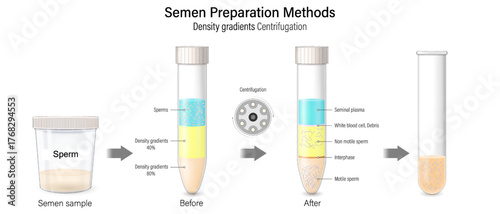 Semen Preparation Methods-Density gradients Centrifugation. Sperm selection for IVF. In-Vitro Fertilization. Fertility treatment. Assisted reproductive technology.