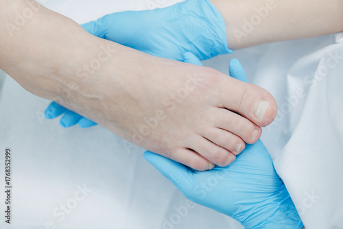 Close-up of foot examined by medical professional wearing blue gloves, podiatrist treatment