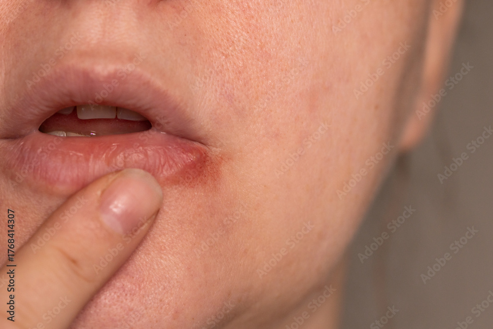 Obraz premium Close-up detail shows finger touching a cold sore on the lower lip of a woman's face. Skin is visible around the lips. Redness and swelling indicate Herpes simplex virus.