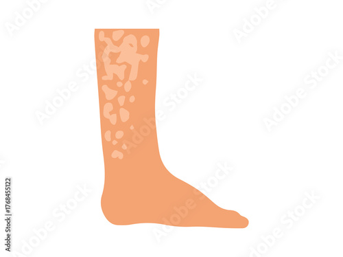 Fungal Tinea Versicolor Illustration