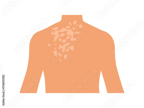 Fungal Tinea Versicolor Illustration