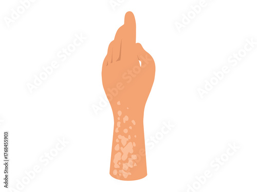 Tinea Versicolor Illustration