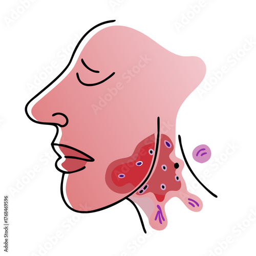 An illustration of a person's profile with highlighted facial and neck swelling/inflammation, suggesting an allergic reaction or infection. Ideal for health blogs.
