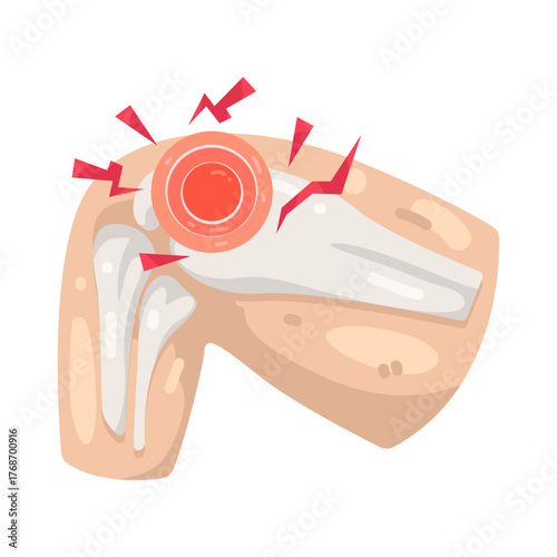 Illustration of Knee Joint Pain