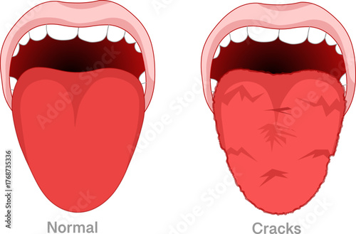 Fissured tongue is also known as scrotal tongue or lingua plicata. Benign condition. Oral diseases. Vector illustration