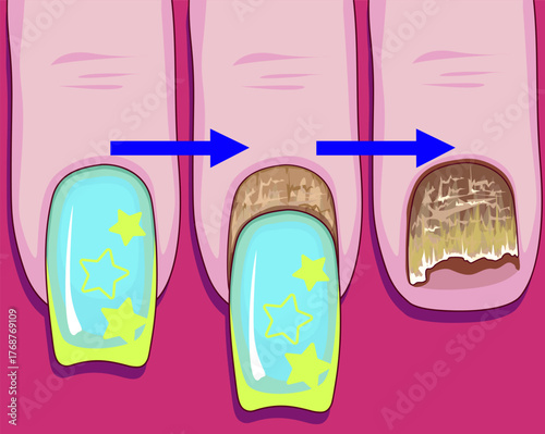 Nail plate disease. Nail plate fungus. Healthcare illustration. Vector illustration.