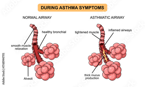 Asthma disease illustration. Asthma attack, shortness of breath. Inflammation of the bronchial tubes, thick mucus in the lungs. Vector illustration for medical, health, and clinics.