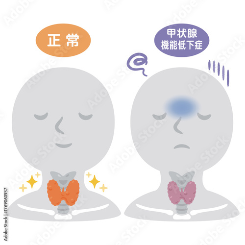 働きが鈍くなっている甲状腺のと元気な甲状腺の人物イラスト／Comparison of Healthy and Underactive Thyroid Glands on Human Silhouette