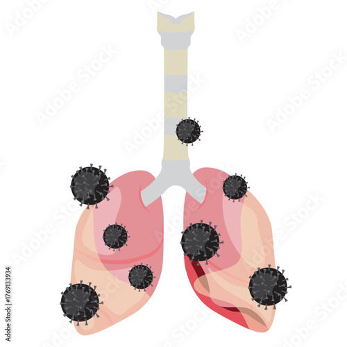 Pneumonia Illustration
