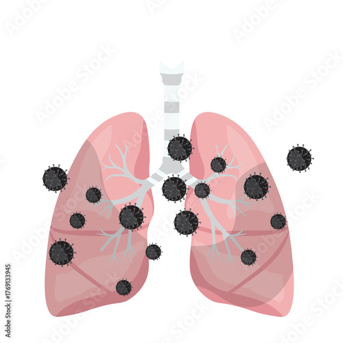 Pneumonia Illustration