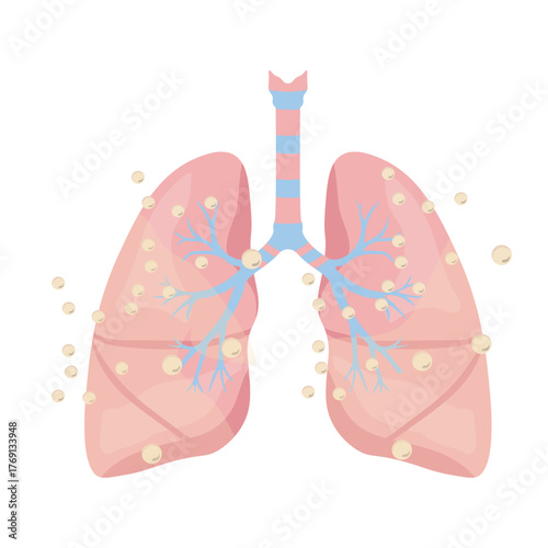 Pneumonia Illustration