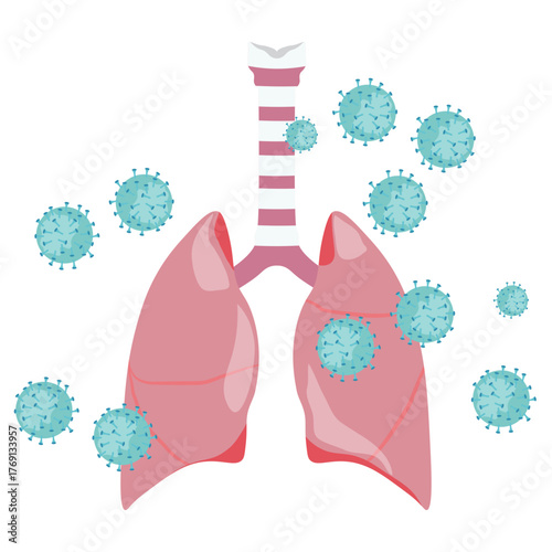 Pneumonia Illustration