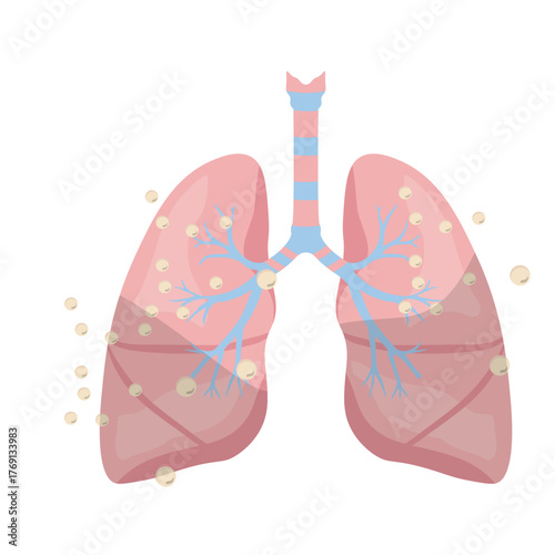 Pneumonia Illustration