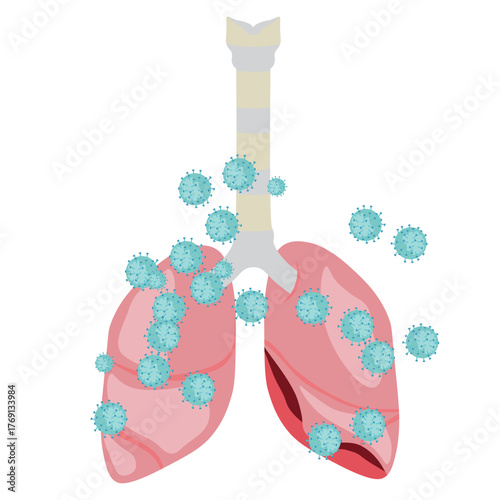 Pneumonia Illustration