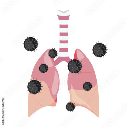 Pneumonia Illustration