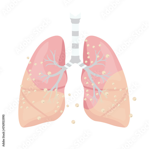 Pneumonia Illustration