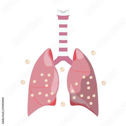 Pneumonia Illustration