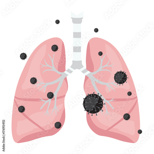 Pneumonia Illustration