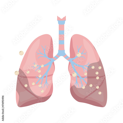 Pneumonia Illustration