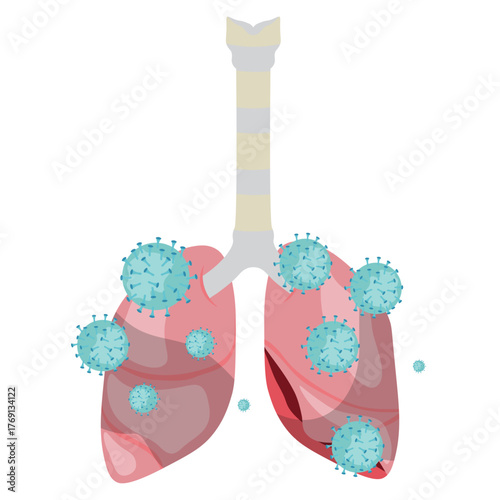 Pneumonia Illustration