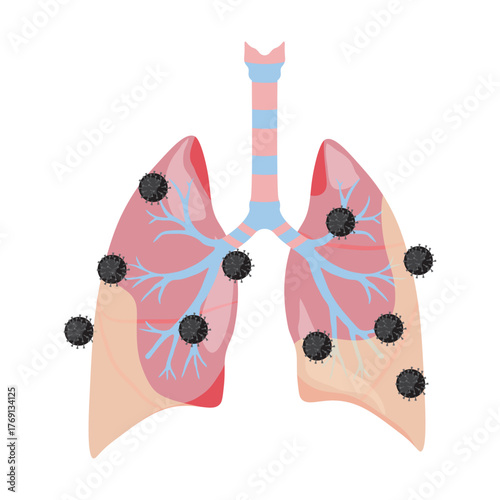 Pneumonia Illustration